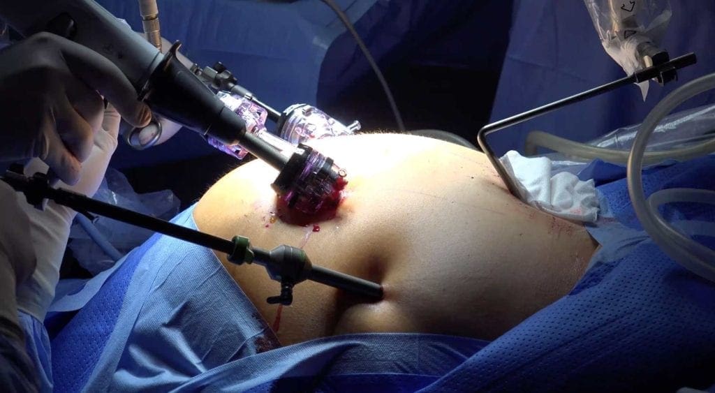 bariatric surgery costs