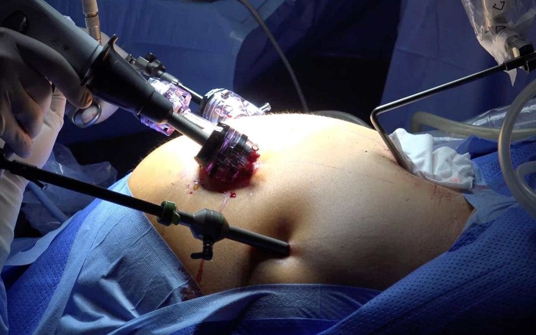 Comparing Bariatric Surgery and Endoscopic Sleeve Gastroplasty – ESG