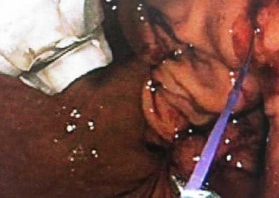 Stomach medical procedure