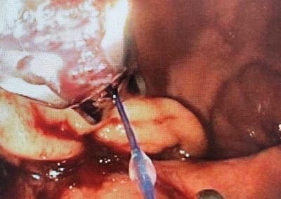 Stomach medical procedure